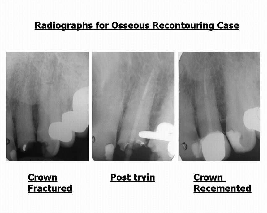 Resize of radiographs for osseous case.jpg